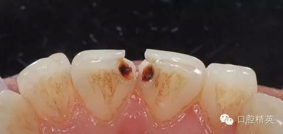 前牙树脂分层堆塑
