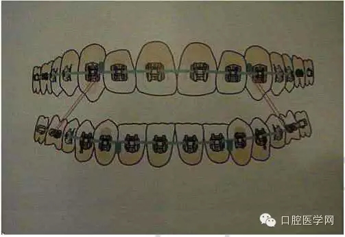 正畸damon system橡皮筋(elastics)挂法示意图