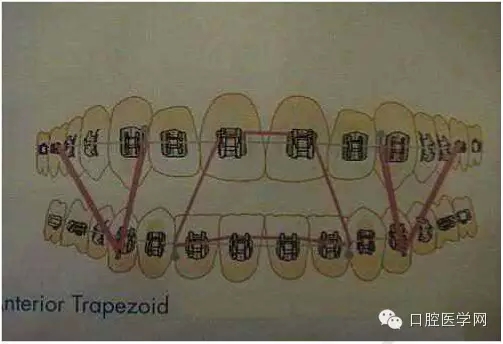 正畸damon system橡皮筋(elastics)挂法示意图