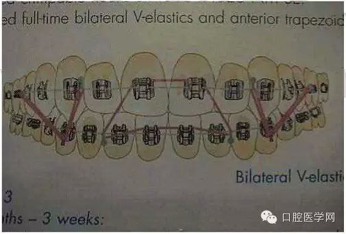 正畸damon system橡皮筋(elastics)挂法示意图