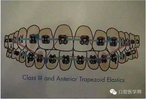 正畸damon system橡皮筋(elastics)挂法示意图