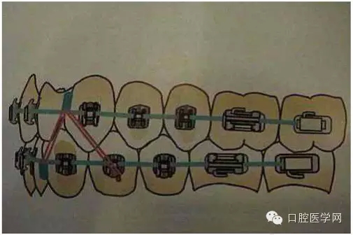 正畸damon system橡皮筋(elastics)挂法示意图