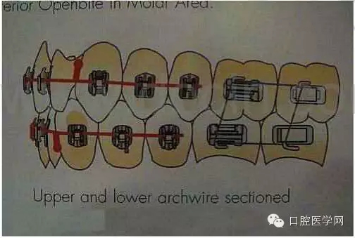 正畸damon system橡皮筋(elastics)挂法示意图