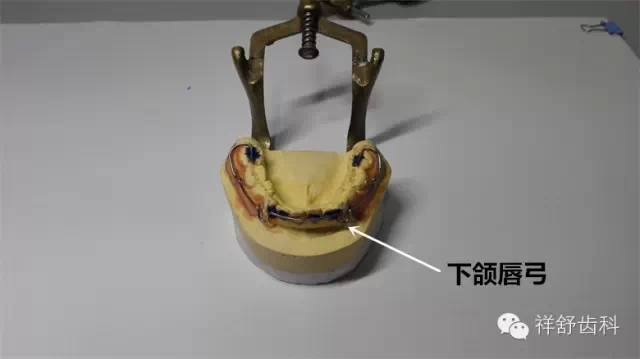 图解Frankel-Ⅲ功能矫治器制作步骤