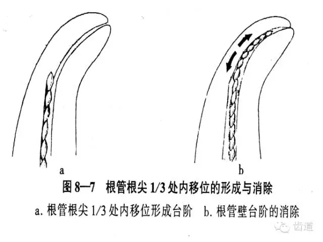 根管治疗的并发症及处理