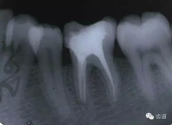 根管治疗的并发症及处理