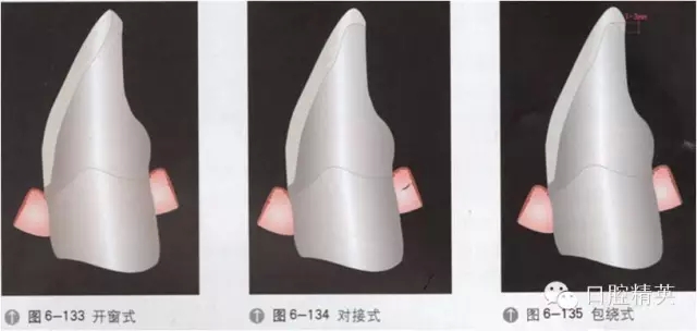 超薄瓷贴面介绍与临床操作步骤