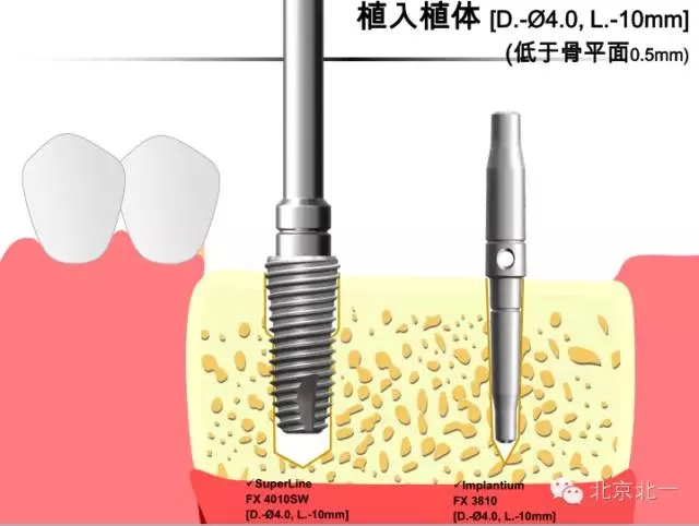 种植】韩国dentium种植体植入外科流程 最后:接愈合基台或者覆盖螺丝