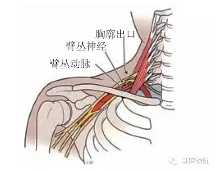 定义 颈部和肩部臂丛神经,血管受压造成的手指,手腕部的疼痛. 2.