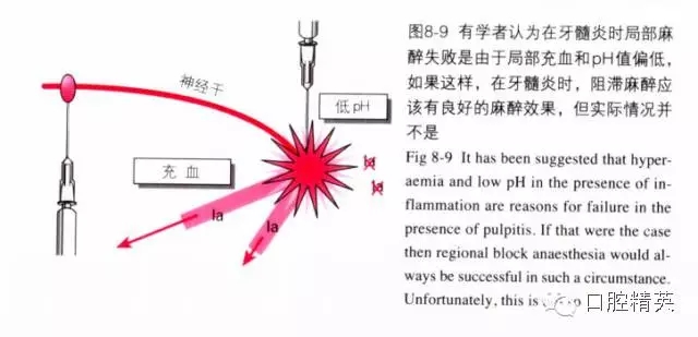 分析局部麻醉失败的常见原因