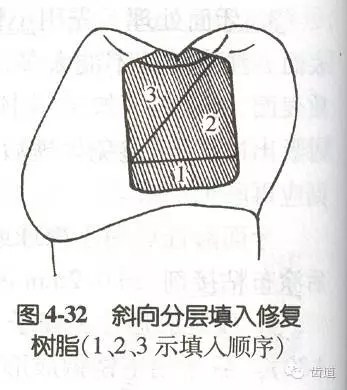 黏结修复的九大操作程序及九大失败原因