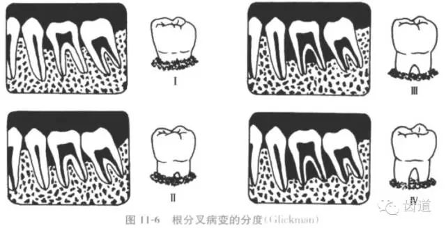 中心 关注牙周 牙周病病历书写,检查大全 3,牙石及出血 4,根分叉病变