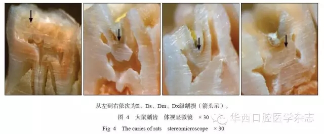 变异链球菌耐酸毒力因子质子移位膜atp酶在龋病进展中的动态变化