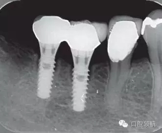 种植体周围出现伴有骨密度增加现象的骨吸收
