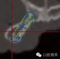 口腔种植各种失败模式的病因探查