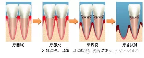 牙龈炎-牙周病(不痛,不痒)不容忽视