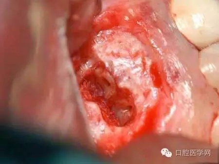 根尖切除术操作全过程