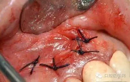 高清图文:根尖切除术操作全过程
