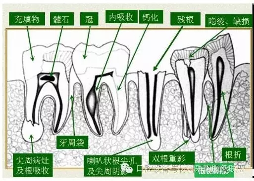 超实用的根管口的探查术