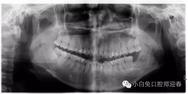 一例智齿断根进行二次拔除的感悟