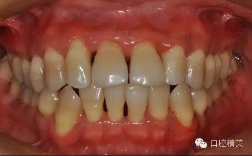 在此阶段要定期复查,检查患者菌斑控制情况,牙龈炎症情况,牙周袋深度