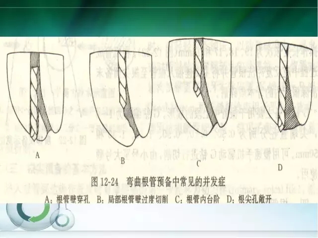 根管治疗并发症及处理