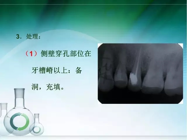 根管治疗并发症及处理