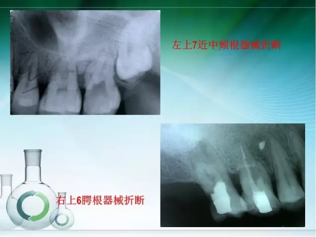 根管治疗并发症及处理