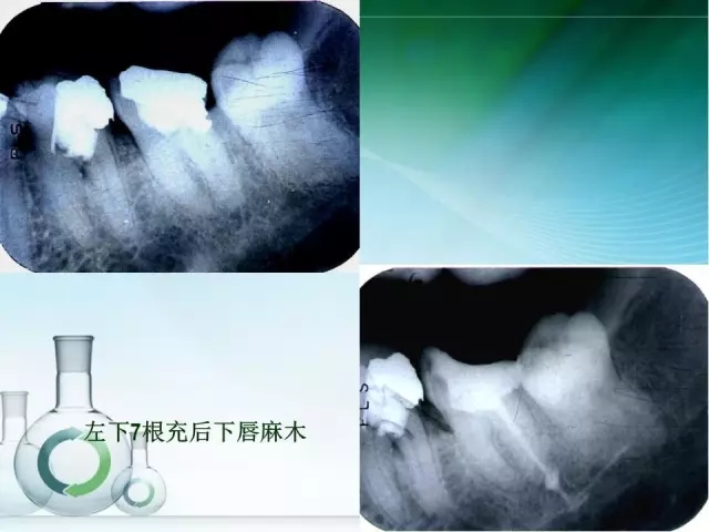 根管治疗并发症及处理