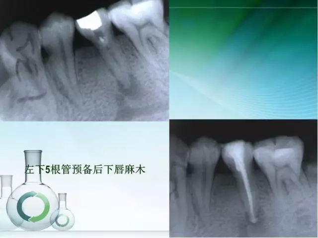 根管治疗并发症及处理