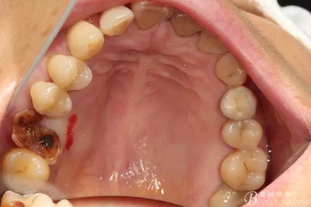 左上后牙巨大拔牙窝即刻种植 右下前磨牙简单即刻种植