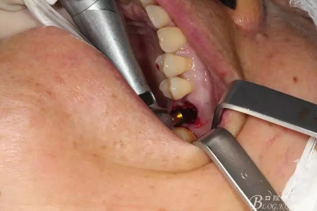 左上后牙巨大拔牙窝即刻种植 右下前磨牙简单即刻种植