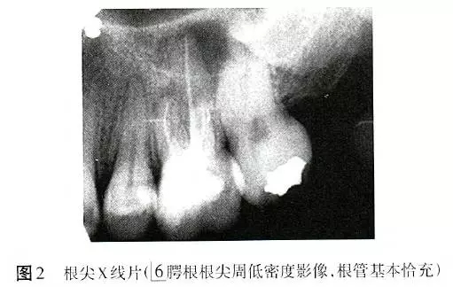 根管治疗