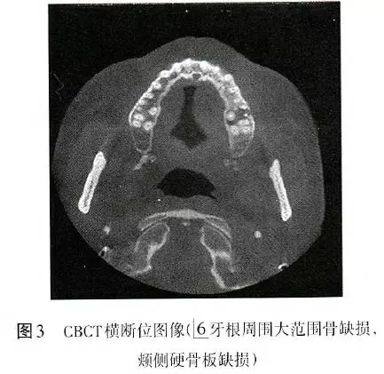 根管治疗