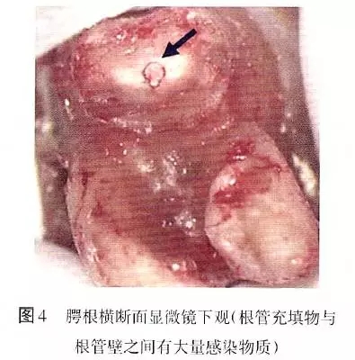 根管治疗