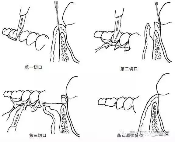内斜切口的不同水平:嵴顶原位复位瓣的切口;根向复位瓣时应从龈缘