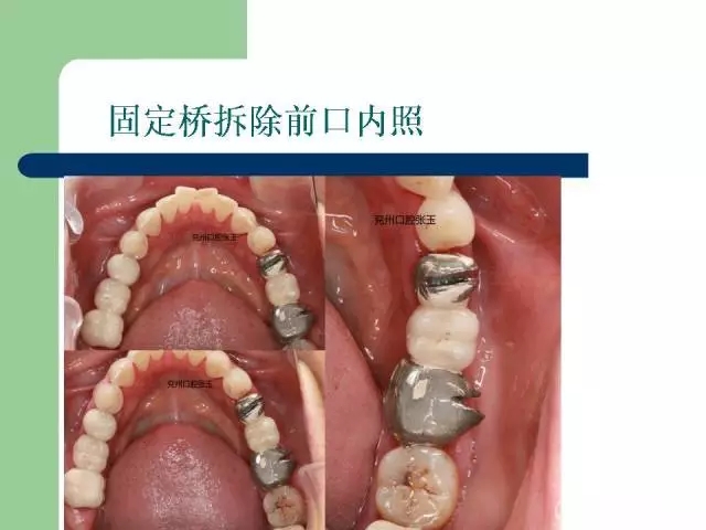 左下后牙不良修复体拆除后重新修复一例