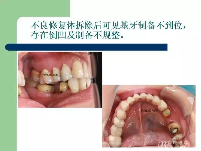 左下后牙不良修复体拆除后重新修复一例