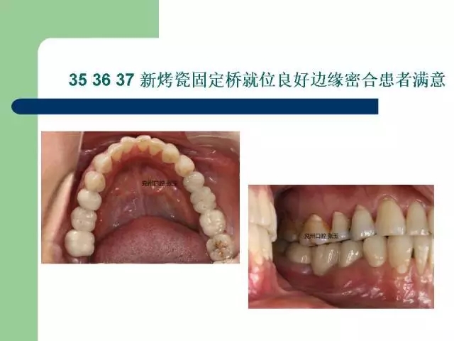 左下后牙不良修复体拆除后重新修复一例