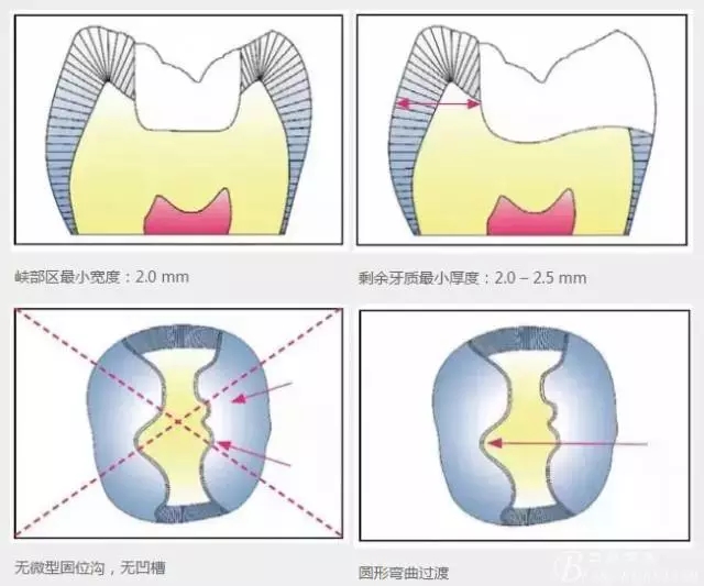 嵌体制备细节详解