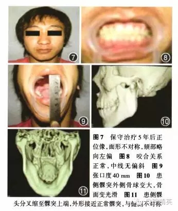 儿童口腔下颌骨髁突矢状骨折保守治疗临床观察13年一例