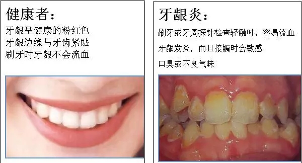 【科普】牙周病的预防和治疗