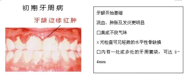 【科普】牙周病的预防和治疗