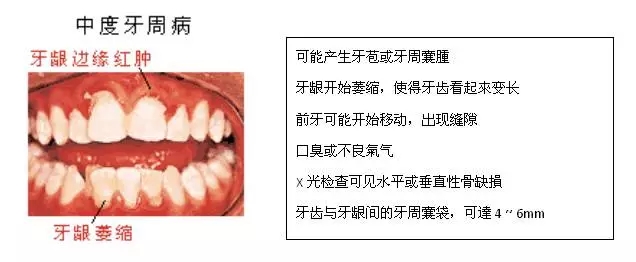 【科普】牙周病的预防和治疗