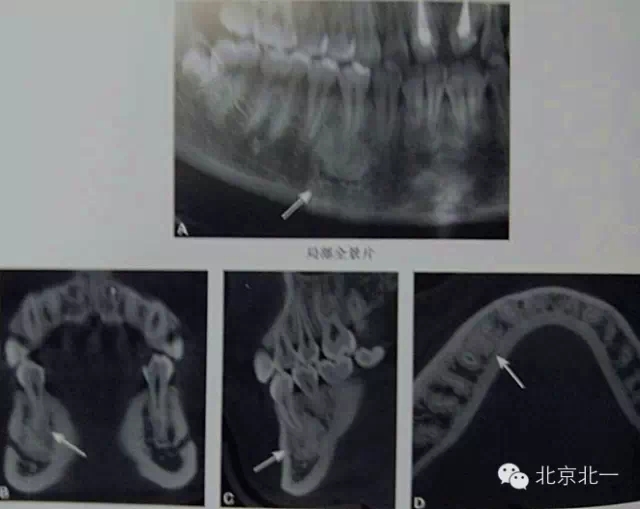 【口腔种植】致密性骨炎/牙骨质增生/骨岛如何鉴别?