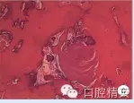 颌骨良性成牙骨质细胞瘤