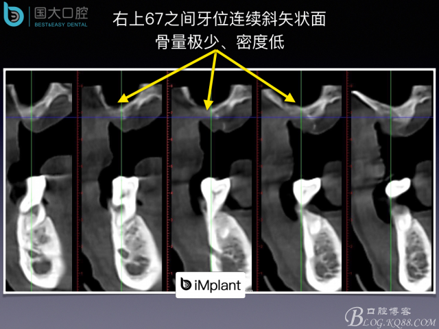 上颌窦底区域严重骨吸收的临床种植案例.jpeg