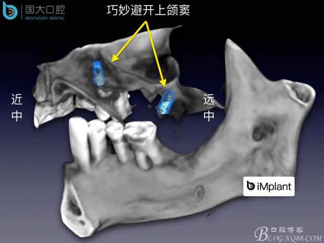 上颌窦底区域严重骨吸收的临床种植案例.jpeg