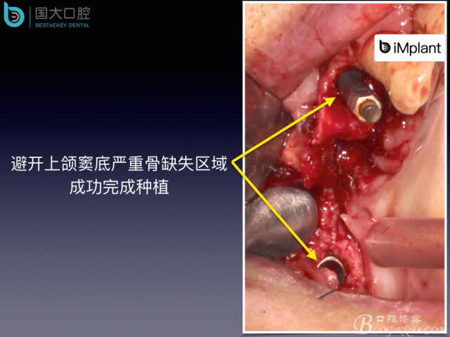 上颌窦底区域严重骨吸收的临床种植案例.jpeg