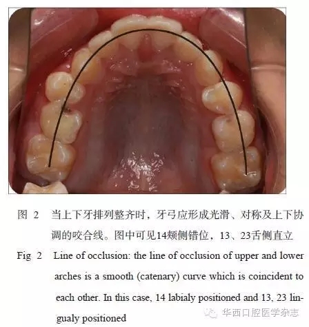 牙弓/牙槽骨弓的塑形矫治——基于牙弓形态发育不良的